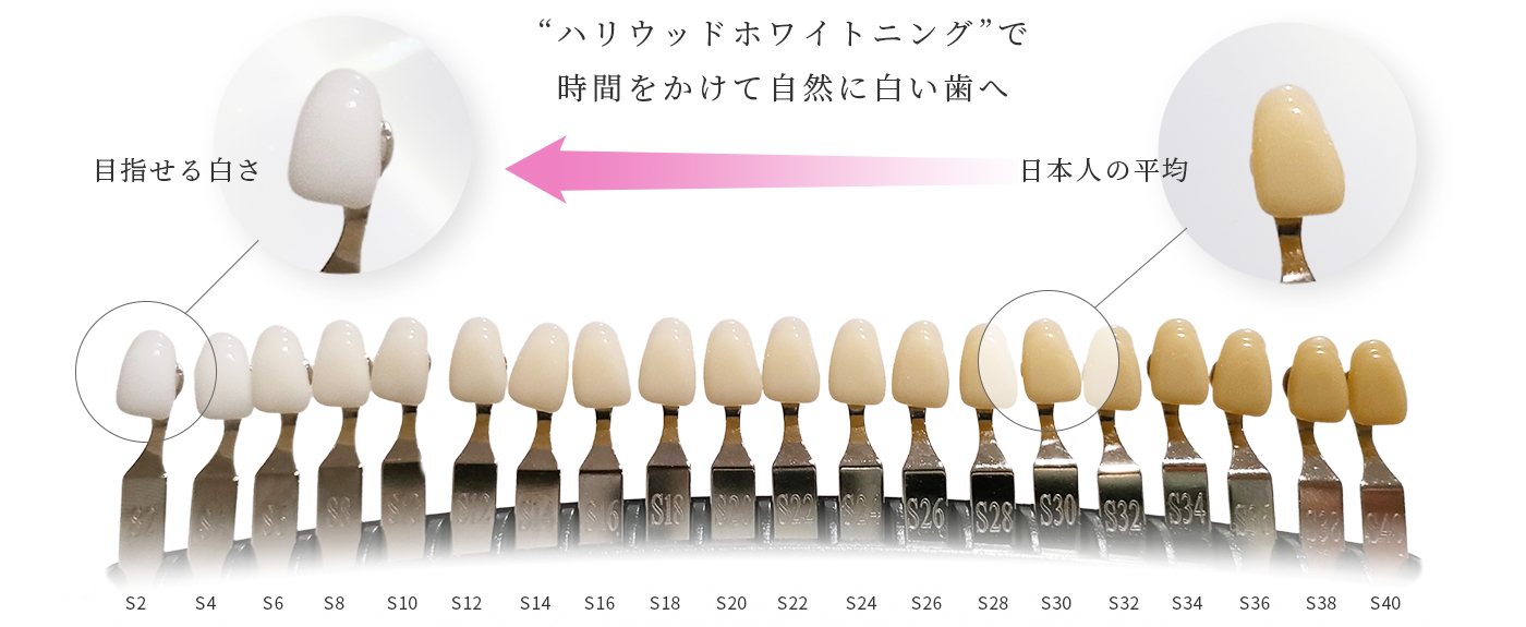 ハリウッドプホワイトニングで時間をかけて自然に白い歯へ