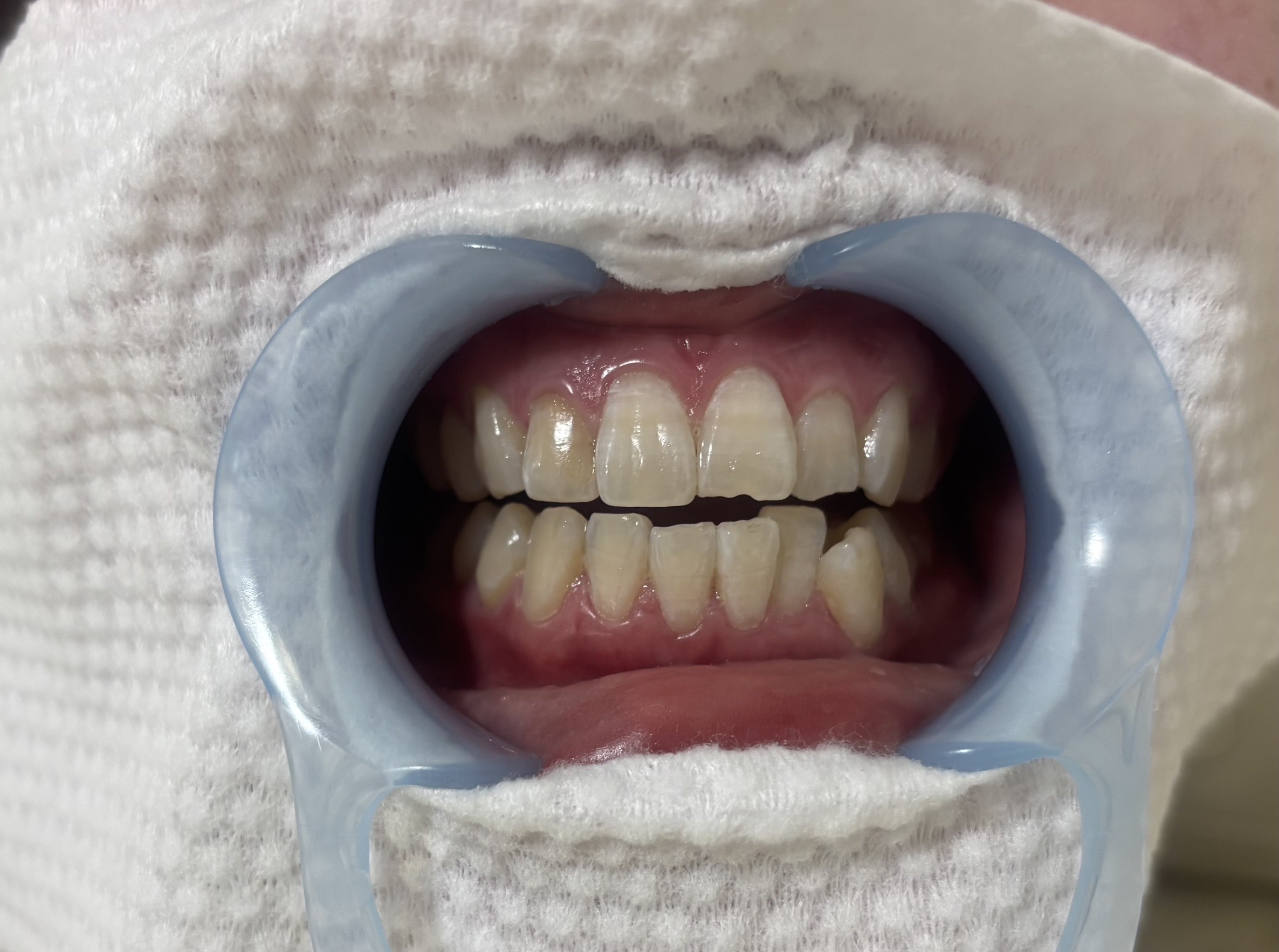 ホワイトニング施術後（初回）