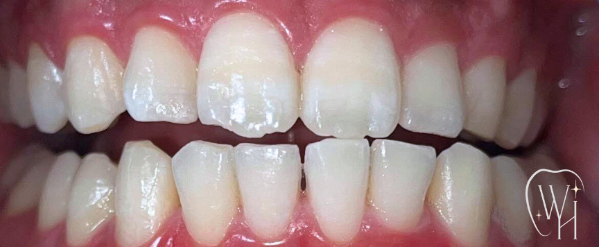 ホワイトニング施術後 白くなった歯（症例8）
