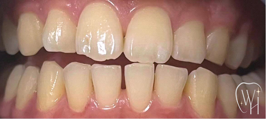 ホワイトニング施術前の歯（症例8）