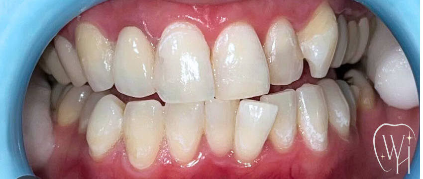 ホワイトニング施術後 白くなった歯（症例7）