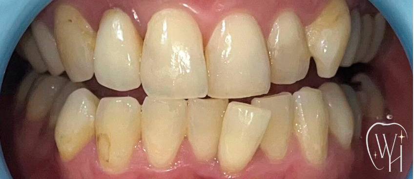 ホワイトニング施術前の歯（症例7）