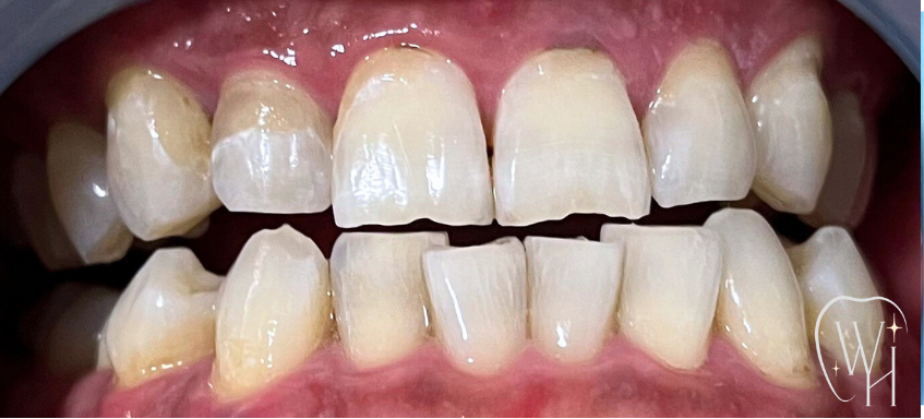 ホワイトニング施術後 白くなった歯（症例6）