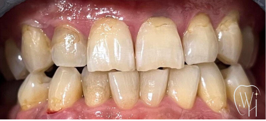 ホワイトニング施術前の歯（症例6）