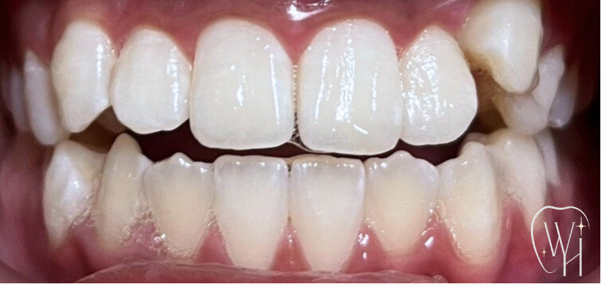 ホワイトニング施術後 白くなった歯（症例5）