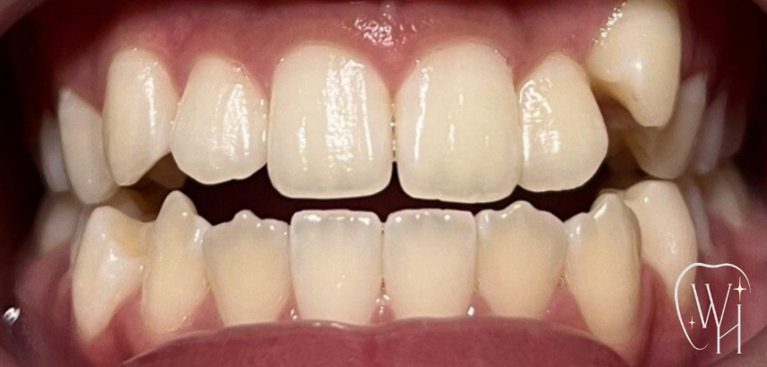 ホワイトニング施術前の歯（症例5）
