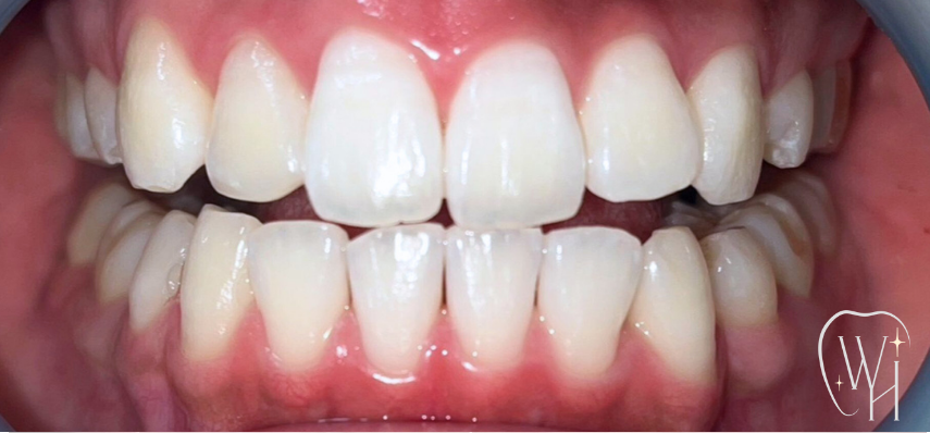 ホワイトニング施術後 白くなった歯（症例4）