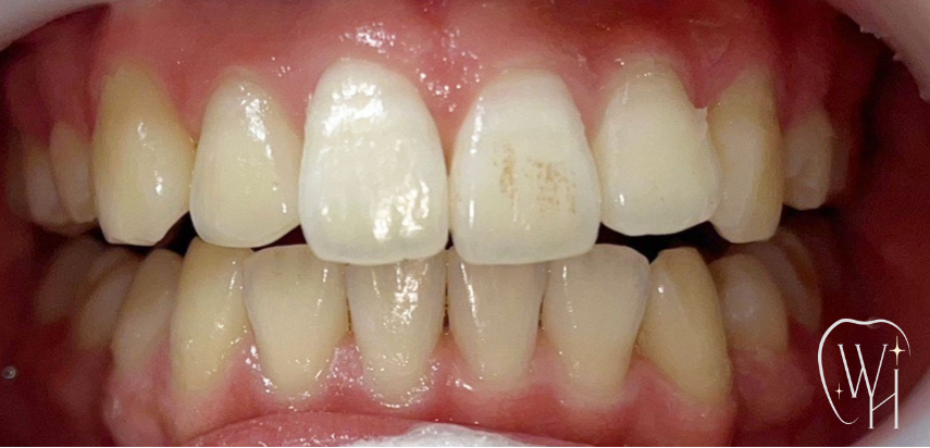ホワイトニング施術前の歯（症例4）