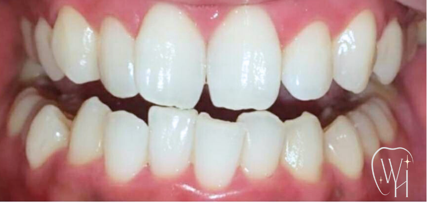 ホワイトニング施術後 白くなった歯（症例3）
