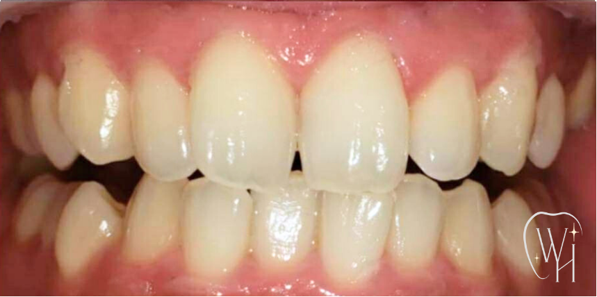 ホワイトニング施術前の歯（症例3）