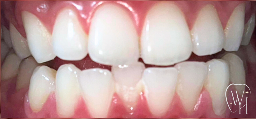 ホワイトニング施術後 白くなった歯（症例2）