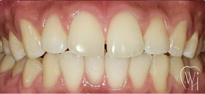 ホワイトニング施術前の歯（症例2）