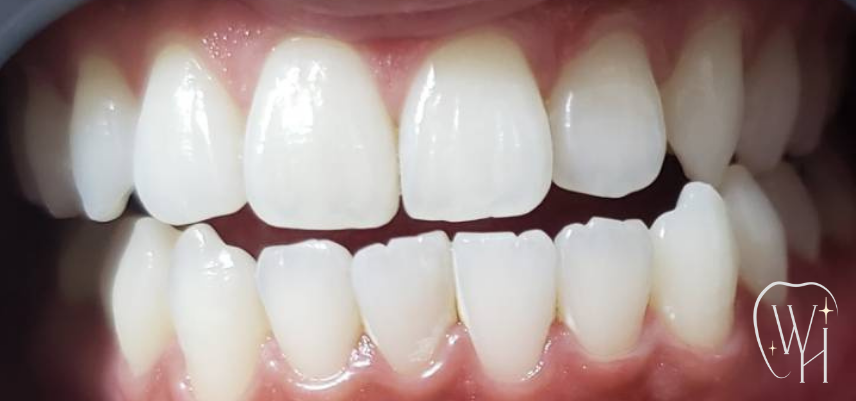 ホワイトニング施術後 白くなった歯（症例1）
