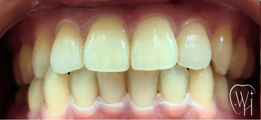 ホワイトニング施術前の歯（症例1）