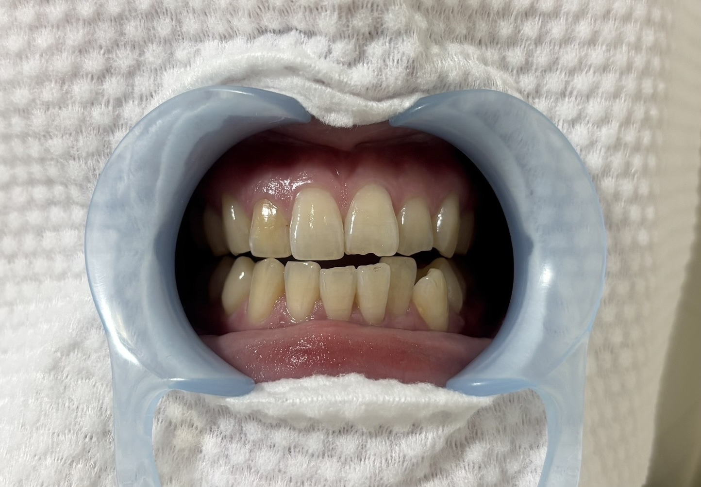 ホワイトニング施術前