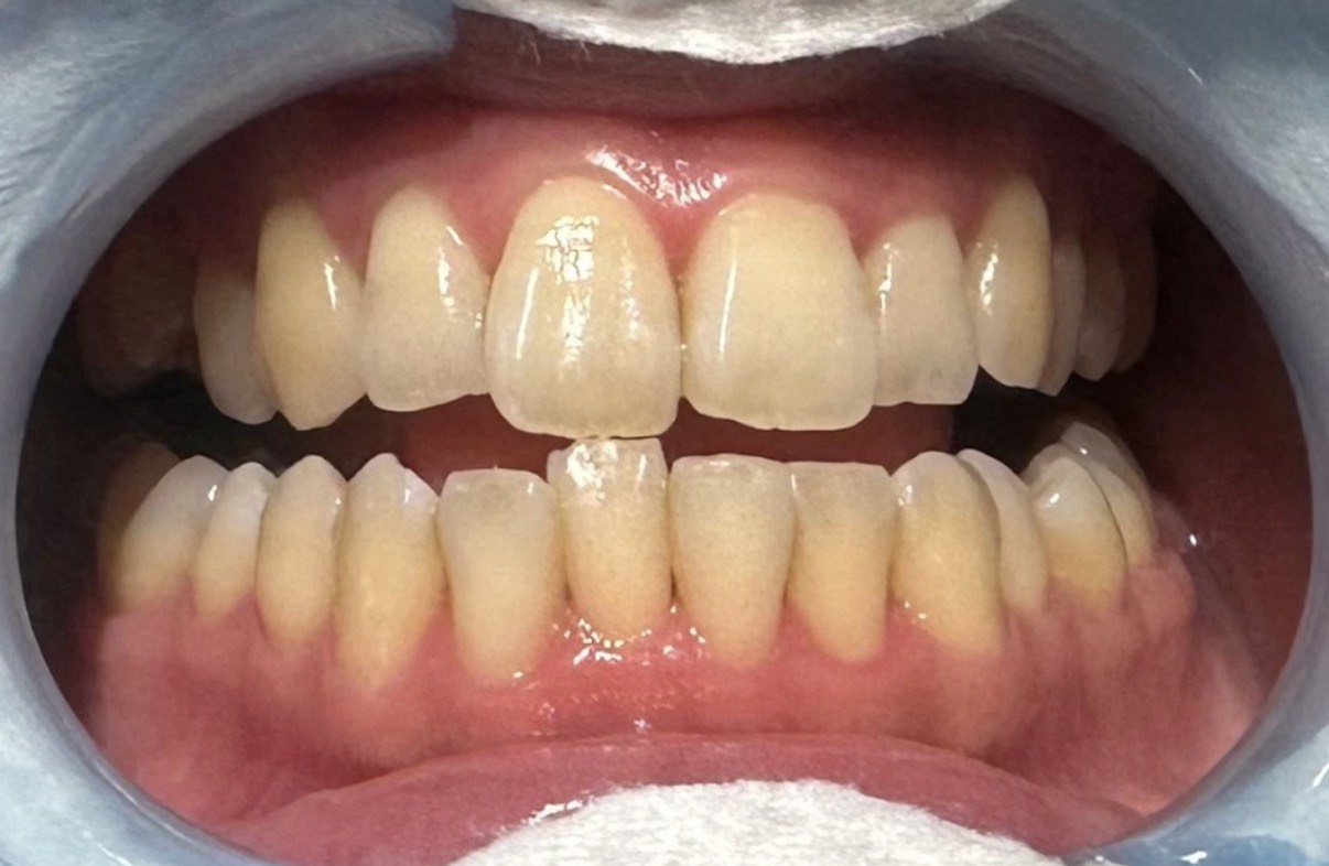 Before